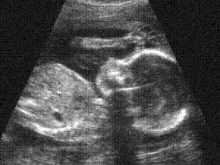 An ultrasound image of an unborn child.