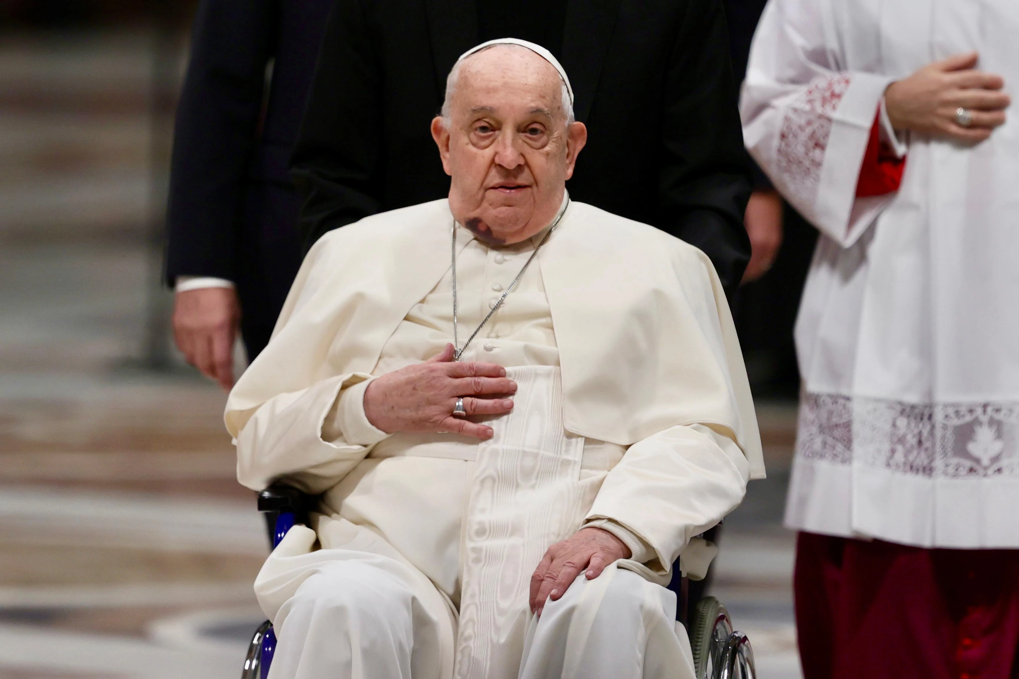 Pope Francis arrives for a consistory at St. Peter's Basilica with visible bruising on his face, Vatican City, Dec. 7, 2024. Vatican spokesman Matteo Bruni explained that the pope suffered a contusion after hitting his chin on a bedside table the previous morning.?w=200&h=150